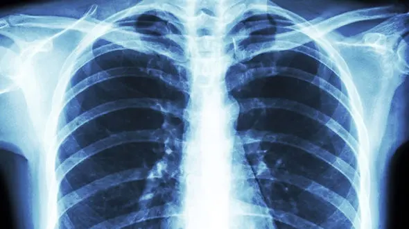 درگیری ریه بعد از بهبودی از کرونا هم ادامه دارد!