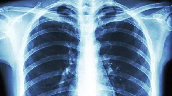 درگیری ریه بعد از بهبودی از کرونا هم ادامه دارد!