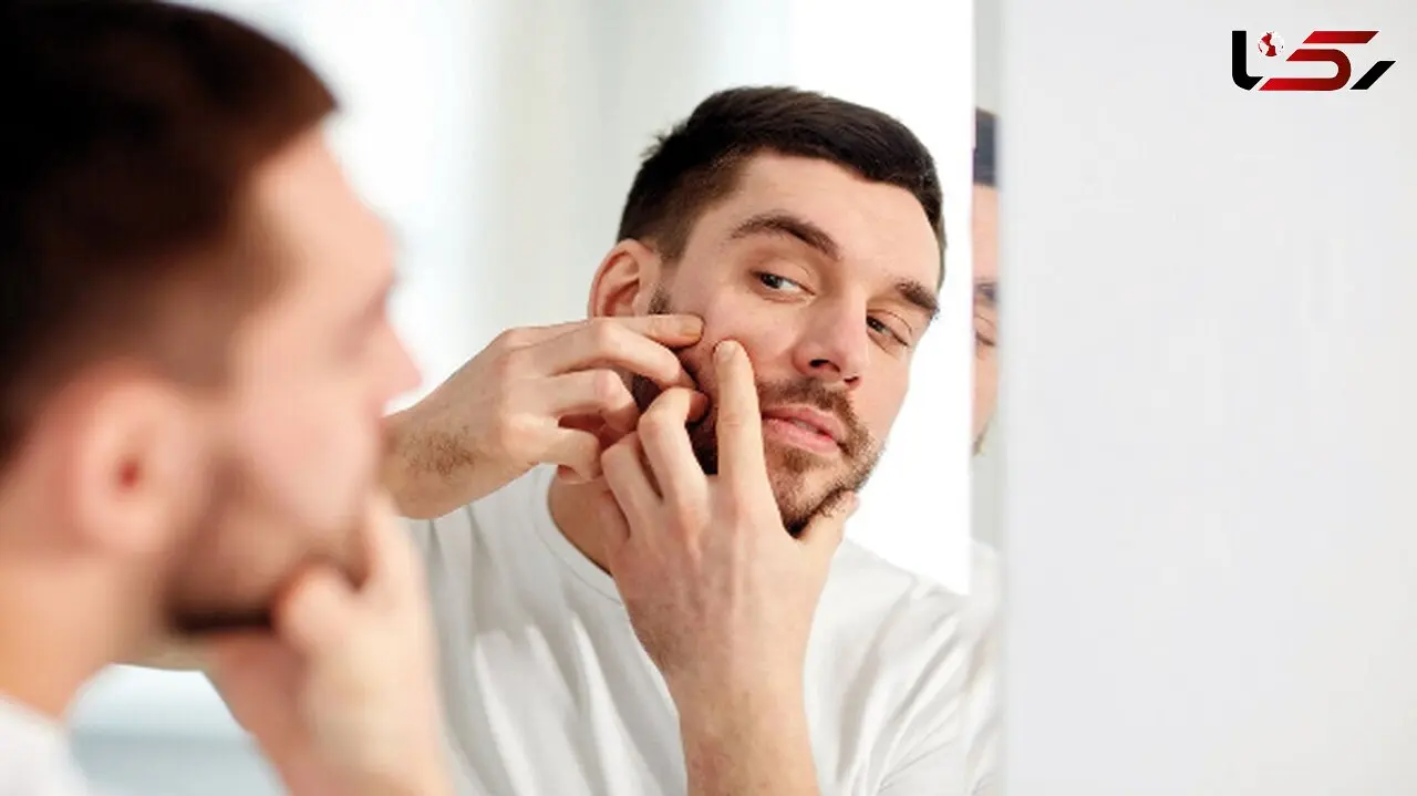 5 ترکیب اثبات‌شده برای مبارزه با آکنه