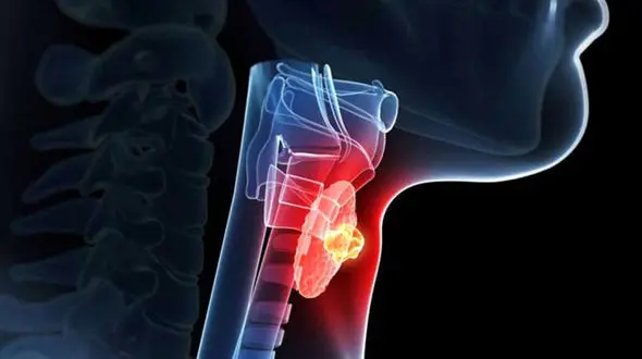 بخور و نخورهای مبتلایان کم کاری تیروئید 