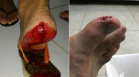 حمله خونین ماهی های گوشتخوار به گردشگران در سواحل برزیل +تصاویر 