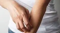 حس راه رفتن حشره روی پوست نشانه چه بیماری است؟