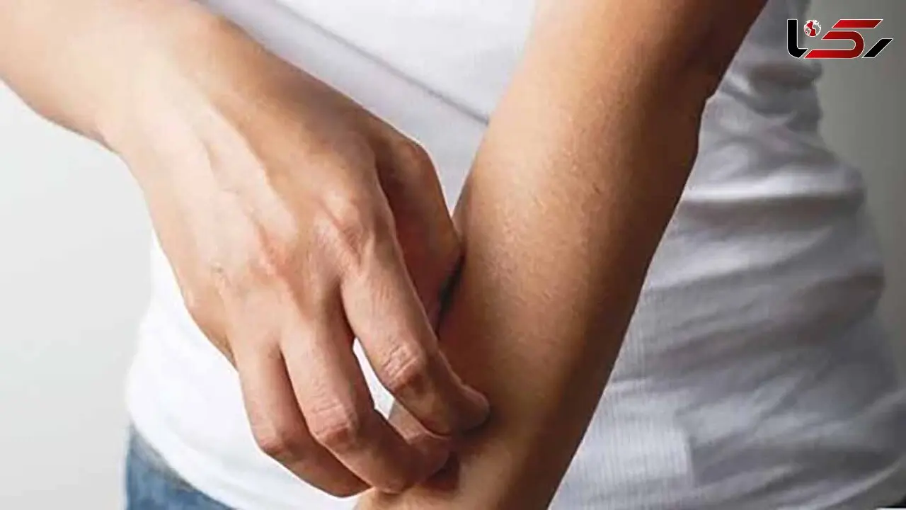 حس راه رفتن حشره روی پوست نشانه چه بیماری است؟