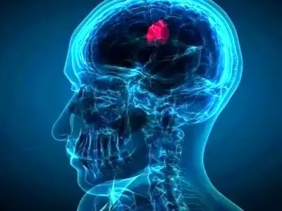 تحولی در درمان سرطان مغز با قطره‌ بینی ویژه