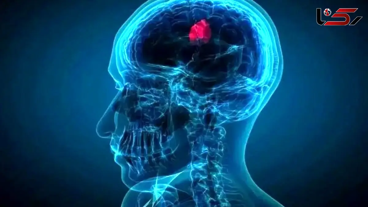 تحولی در درمان سرطان مغز با قطره‌ بینی ویژه