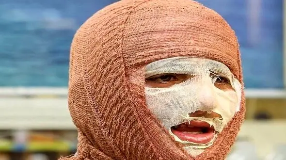 آیا سوختگی های عمیق قابل درمان هستند؟ راهکارهای نوین کدامند؟