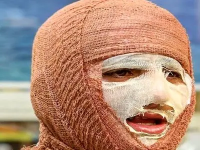 آیا سوختگی های عمیق قابل درمان هستند؟ راهکارهای نوین کدامند؟