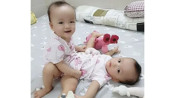 جداسازی دوقلوهای بهم چسبیده با کمک 100 جراح و متخصص + عکس /  ویتنام