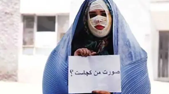 تصویب کلیات طرح تشدید مجازات مرتکبان اسیدپاشی