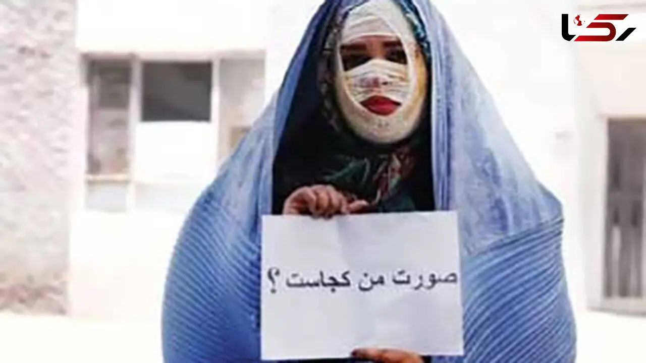 تصویب کلیات طرح تشدید مجازات مرتکبان اسیدپاشی