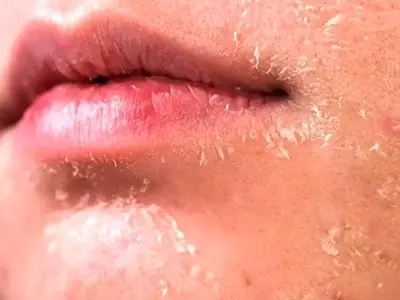 چگونه در زمستان از پوست خود مراقبت کنیم؟ 5 روش کاربردی