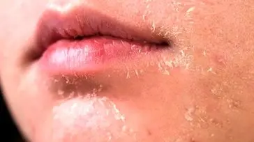 چگونه در زمستان از پوست خود مراقبت کنیم؟ 5 روش کاربردی