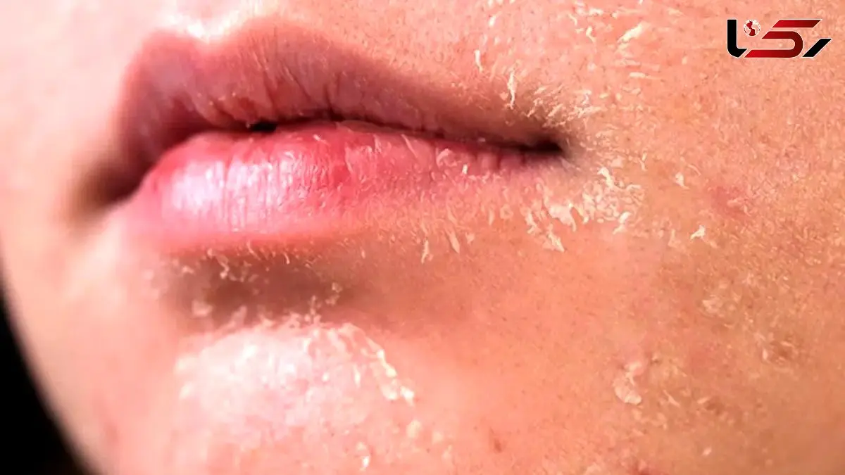 چگونه در زمستان از پوست خود مراقبت کنیم؟ 5 روش کاربردی