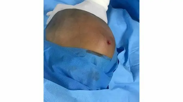 اصابت گلوله به سر کودک 2 ساله لارستانی / او معجزه آسا زنده ماند + عکس