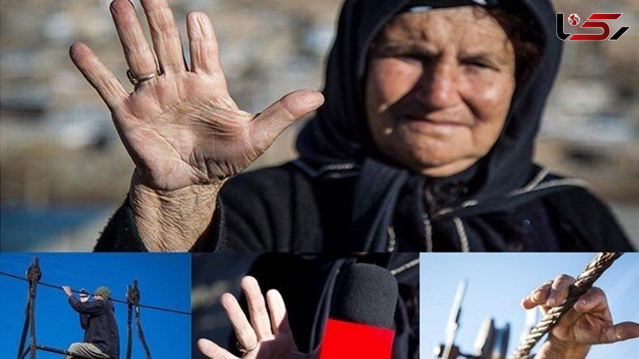 قطع شدن انگشتان اهالی روستایی در لرستان / علت چیست؟!+تصویر 