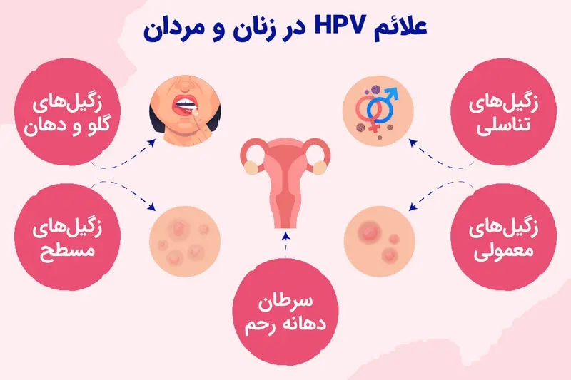 زگیل تناسلی