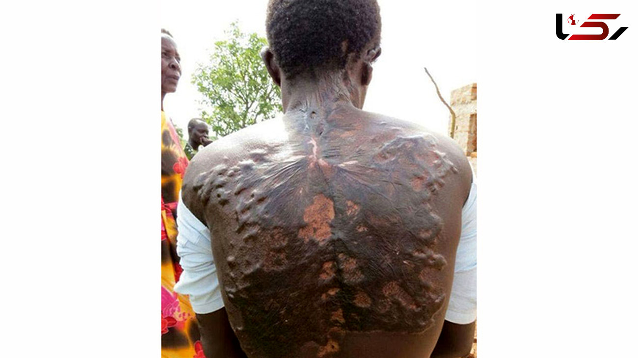 عکس هولناک از بدن مردانی که صاعقه به آن ها خورده است