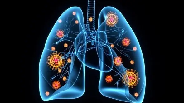 
 ابتلا به ذات‌الریه با کرونا 