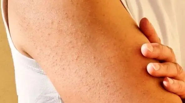 پوست مرغی چیست؟ / درمان پوست مرغی