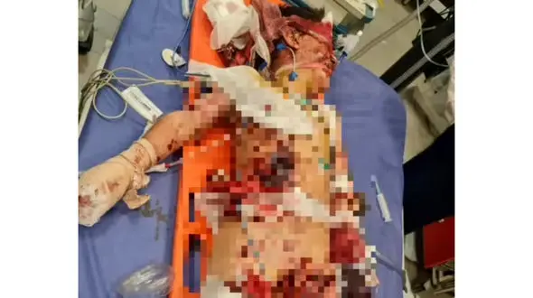 انفجار هولناک مین در یکی از روستاهای سنندج / مین جنگی در دستان ارشیا کوچولو منفجر شد + عکس تلخ