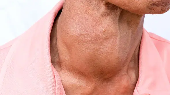 هاشیموتو چیست ؟ + فیلم