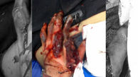 عکس از انفجار نارنجک در دست پسر 19 ساله در بومهن