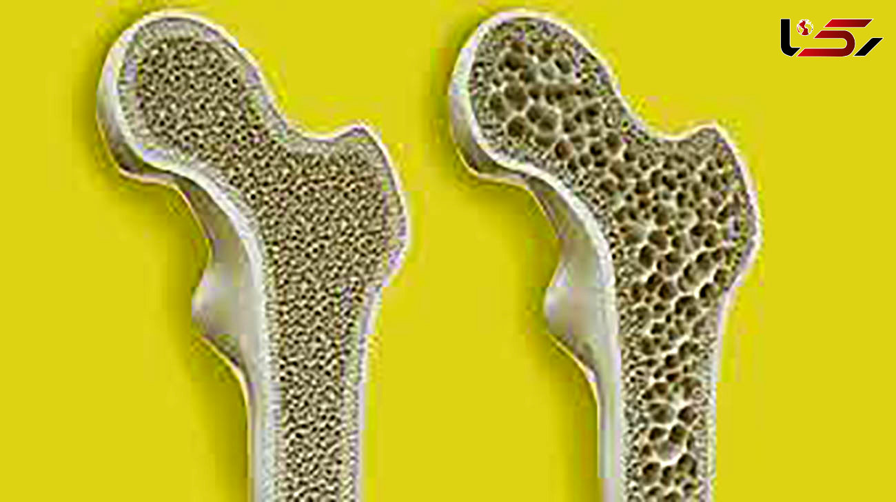 آیا پوکی استخوان با تشخیص زود هنگام قابل درمان است ؟ 