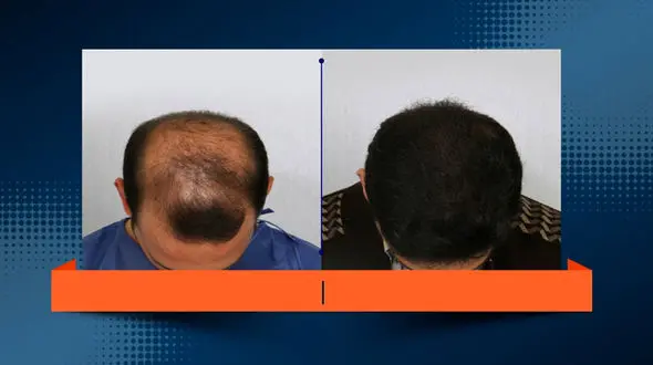 جدیدترین روش کاشت مو در ایران و جهان