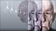 چگونگی ابتلای به آلزایمر از زبان یک متخصص