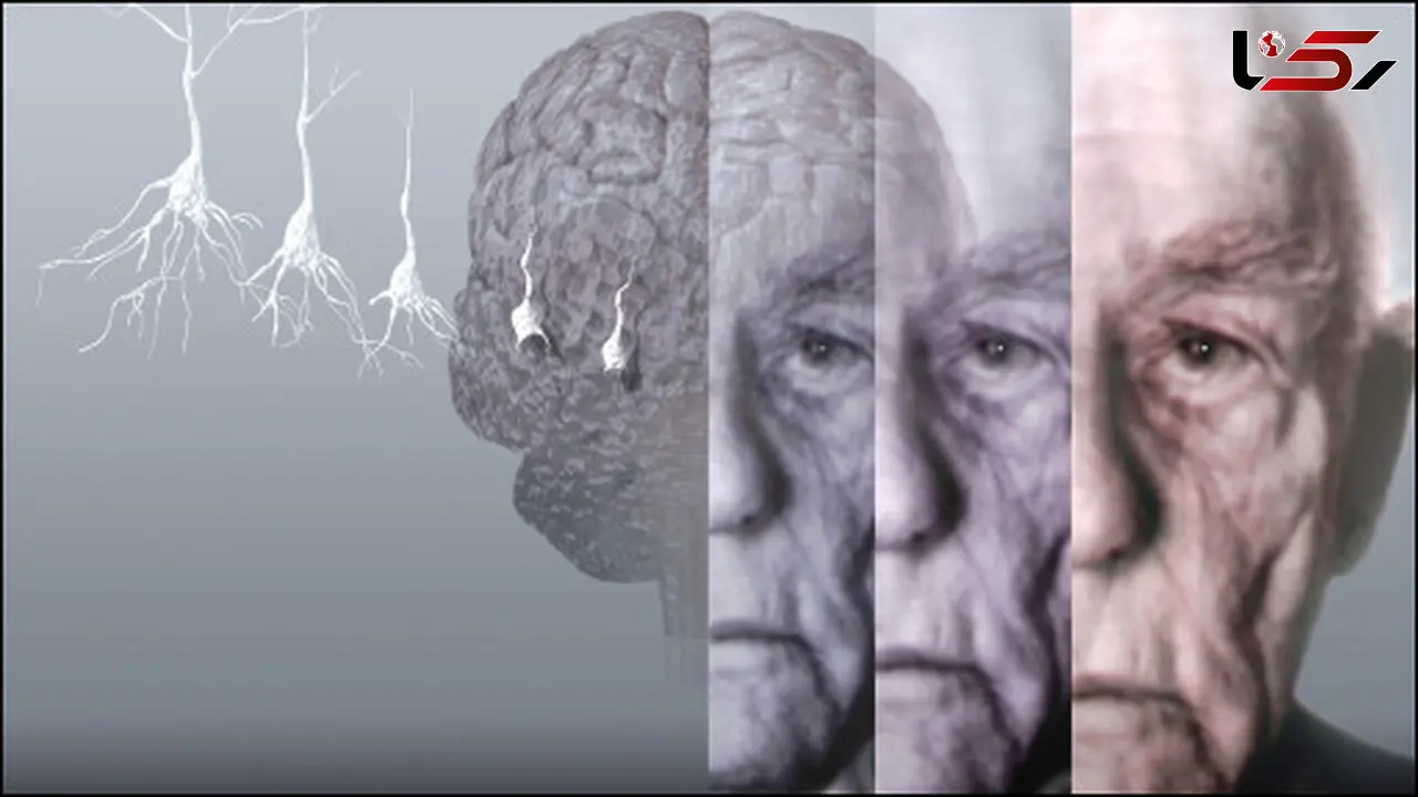 چگونگی ابتلای به آلزایمر از زبان یک متخصص