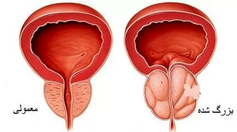 پروستات بزرگ