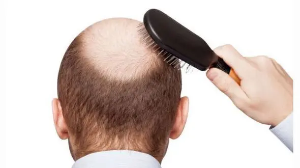 میزان ریزش طبیعی موی سر چقدر باید باشد؟
