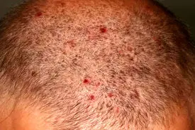 علت جوش در سر چیست؟ + فیلم 