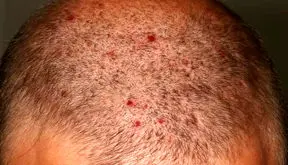 علت جوش در سر چیست؟ + فیلم 