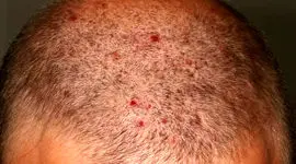 علت جوش در سر چیست؟ + فیلم 