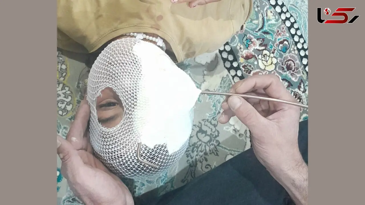 فیلم تکاندهنده از فرو رفتن میله فلزی در چشم دختر بچه در اردبیل