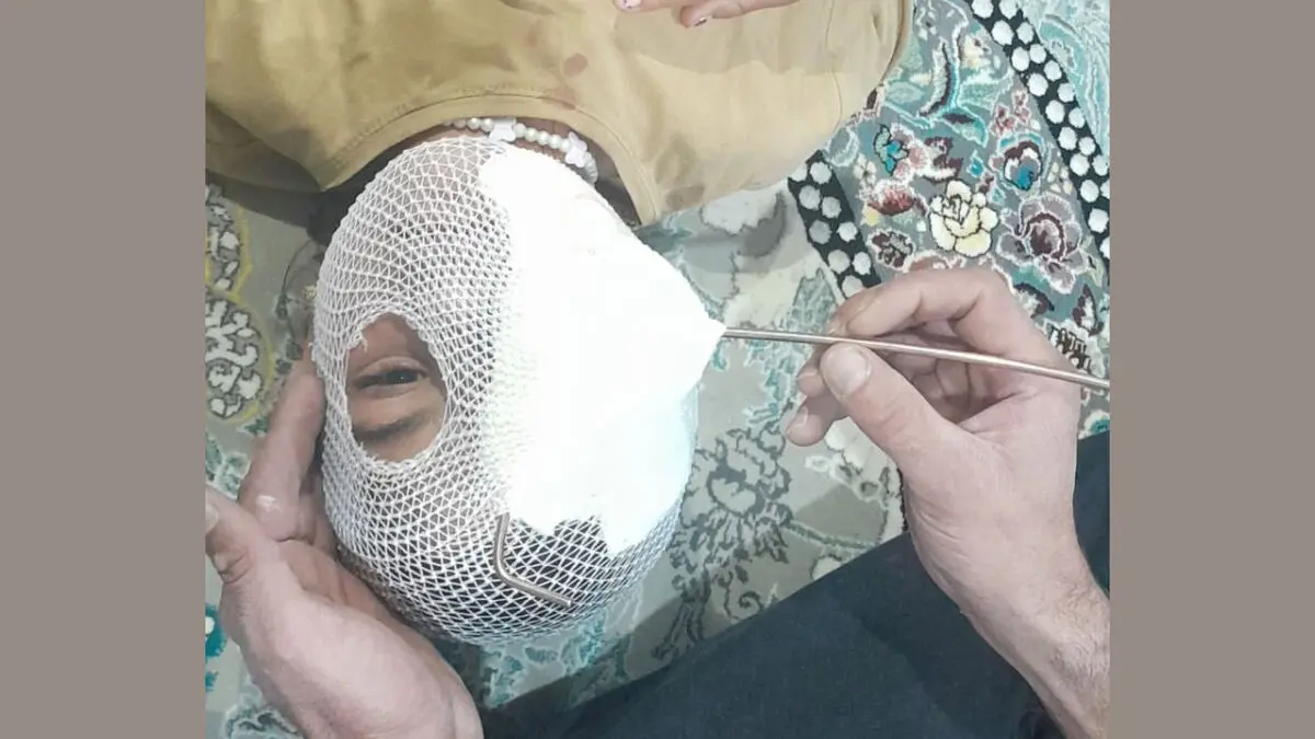 فیلم تکاندهنده از فرو رفتن میله فلزی در چشم دختر بچه در اردبیل