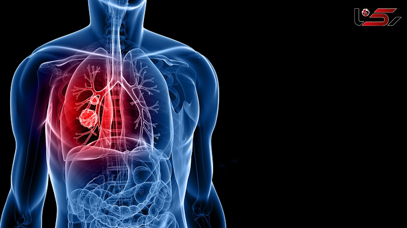 خبر خوش برای بیماران سرطان ریه