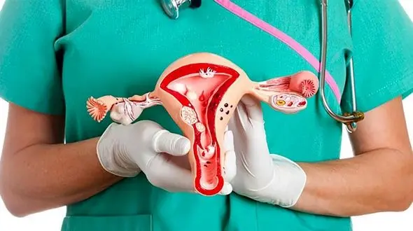 علائم خطرناک سرطان تخمدان