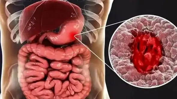 معرفی داروهایی که دومین علت شایع زخم معده هستند