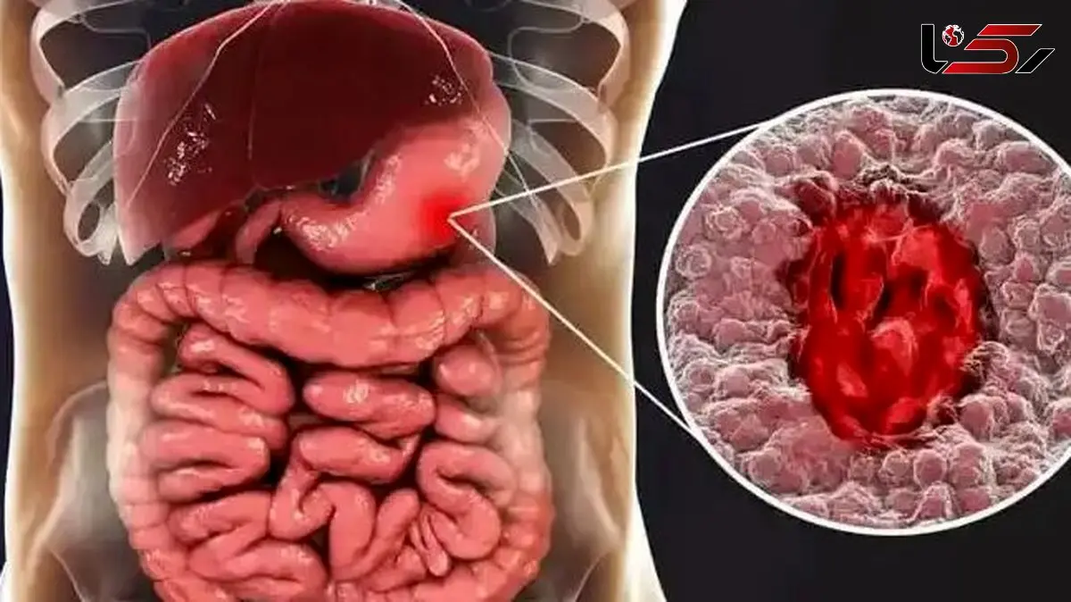 معرفی داروهایی که دومین علت شایع زخم معده هستند