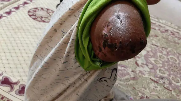 صحبت خانواده حوا ، دختری که دستش طعمه تمساح شد + عکس