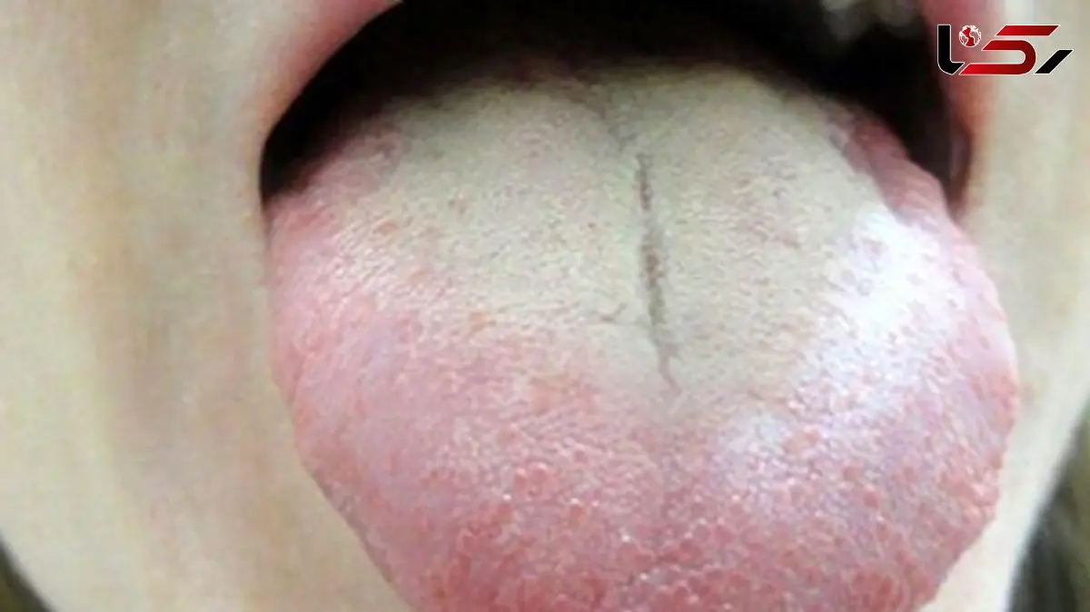 علت سفیدی روی زبان چیست؟