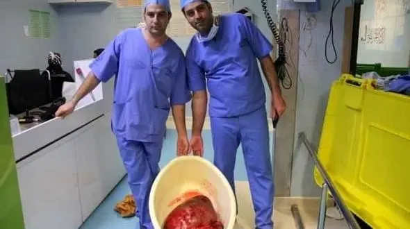 توده ۲۳ کیلوگرمی از شکم یک بیمار در یزد خارج شد + عکس