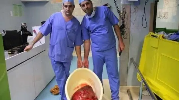 توده ۲۳ کیلوگرمی از شکم یک بیمار در یزد خارج شد + عکس