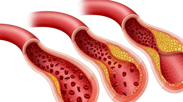 قلبت را خفه نکن!