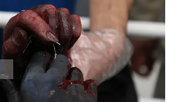 نارنجک چهارشنبه‌سوری انگشت پاکبان شهرداری را قطع کرد