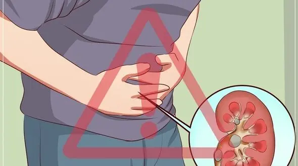 آیا سنگ کلیه موجب بی اختیاری ادرار می گردد؟
