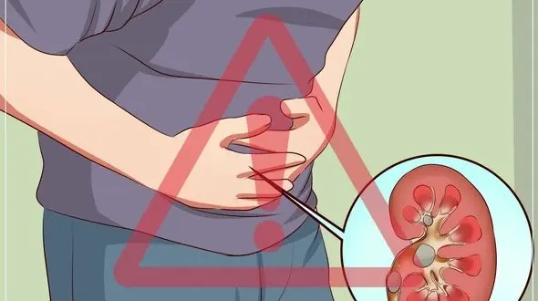 آیا سنگ کلیه موجب بی اختیاری ادرار می گردد؟