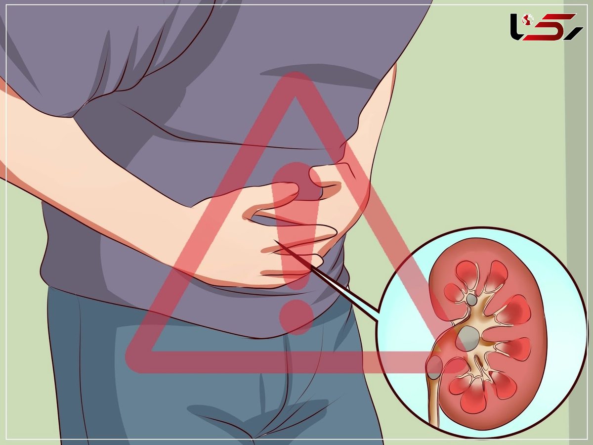 آیا سنگ کلیه موجب بی اختیاری ادرار می گردد؟